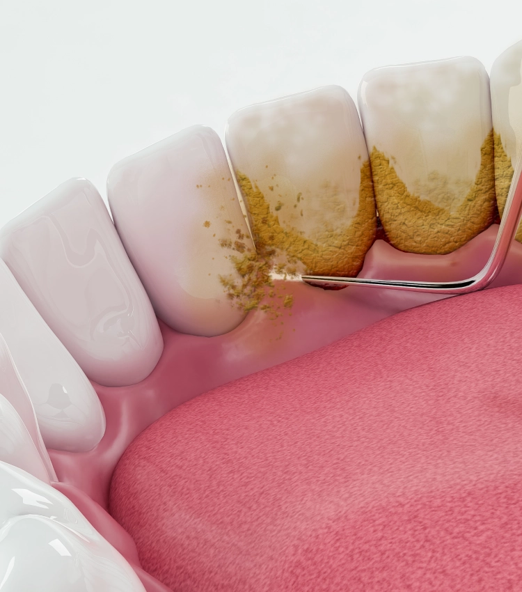 Doğala Diş Kliniği — Periodontoloji